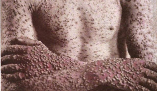 A varíola pode se manifestar de forma violenta, com bolhas em toda a superfície do corpo, causar cegueira e morte. - Gente de Opinião